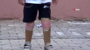 suriyeli-yetim-muhammed-kaybettigi-bacaklarina-turkiyede-kavustu-7ykZyWlT.jpg