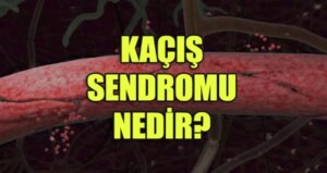 kacis-sendromu-nedir-belirtileri-nelerdir-nasil-tedavi-edilir-rDgMjeB8.jpg
