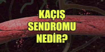 kacis-sendromu-nedir-belirtileri-nelerdir-nasil-tedavi-edilir-rDgMjeB8.jpg