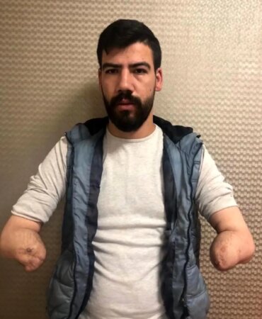 4uncu-cift-kol-nakli-antalyada-yapildi-tzLYgHN9.jpg