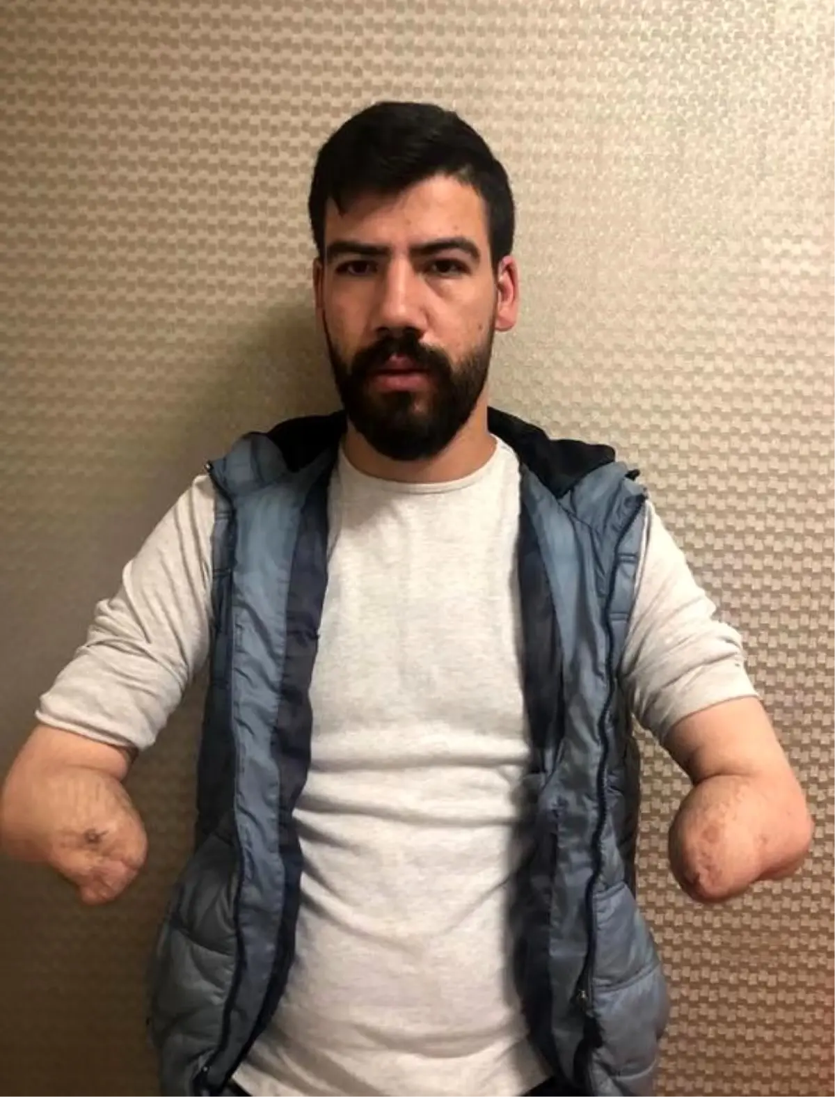 4uncu-cift-kol-nakli-antalyada-yapildi-tzLYgHN9.jpg