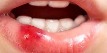 agizdaki-lezyonlar-kanser-belirtisi-olabilir-gOpYlraR.jpg
