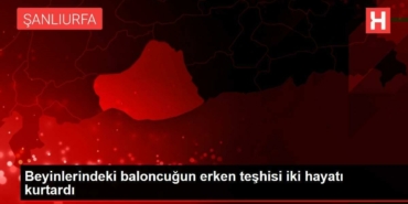 beyinlerindeki-baloncugun-erken-teshisi-iki-hayati-kurtardi-3Qj8J1E9.jpg