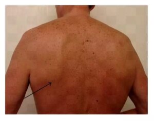 bu-tumor-gunluk-omru-olumsuz-etkileyebiliyor-ulKS3ST3.jpg