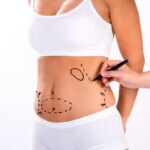liposuction-hakkinda-bilmeniz-gerekenler-HP3E6CSS.jpg