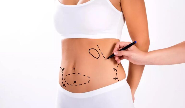 liposuction-hakkinda-bilmeniz-gerekenler-HP3E6CSS.jpg