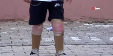 suriyeli-yetim-muhammed-kaybettigi-bacaklarina-turkiyede-kavustu-7ykZyWlT.jpg
