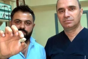 tukuruk-bezinden-3-santimetre-capinda-tas-cikti-2micl5kY.jpg